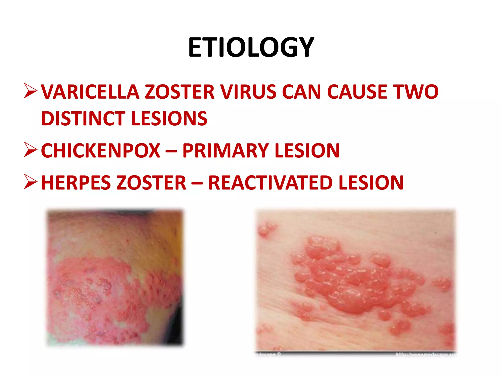 CHICKENPOX ppt | PPTX