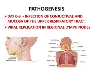 PATHOGENESIS
DAY 0-3 - INFECTION OF CONJUCTIVAE AND
MUCOSA OF THE UPPER RESPIRATORY TRACT.
VIRAL REPLICATION IN REGIONAL LYMPH NODES
 