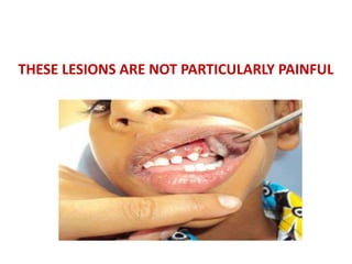 THESE LESIONS ARE NOT PARTICULARLY PAINFUL
 