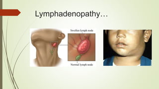 Syphilis | PPTX