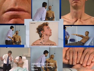 jugular venous pulse-
indicates right heart
failure
 