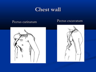 Chest wall
Pectus carinatum      Pectus excavatum
 