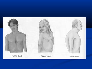 Barrel Chest In Children