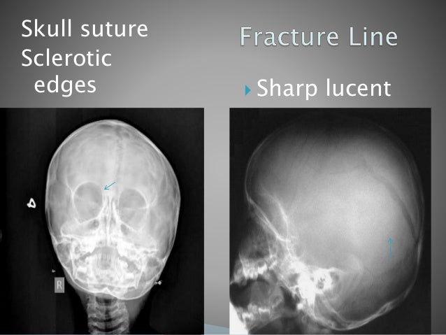 skull fractures vs accessory sutures