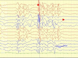 14
Fp1-F3
F3 –C3
C3 – P3
P3 – O1
Fp2 F4
F4 – C4
C4 – P4
P4 – O2
Fp1 –F7
F7 – T3
T3 – T5
T5 – O1
Fp2 F8
F8 – T4
T4 – T6
T6 – O2
EKG
 