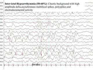 27
Awake
Inter-ictal Hypsarrthymmia (50-60%): Chaotic background with high
amplitude delta,asynchronous multifocal spikes, polyspikes and
electrodecremental activity
 