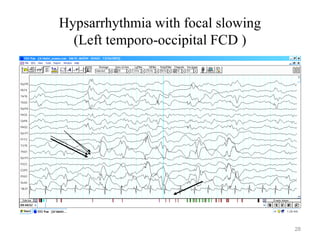 Hypsarrhythmia with focal slowing
(Left temporo-occipital FCD )
28
 