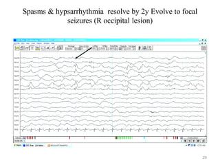 Spasms & hypsarrhythmia resolve by 2y Evolve to focal
seizures (R occipital lesion)
29
 