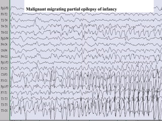 Migrating seizures of infantile
48
Malignant migrating partial epilepsy of infancy
 
