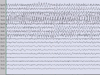 Migrating seizures of infantile
49
 