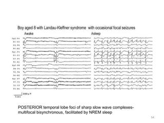 54
POSTERIOR temporal lobe foci of sharp slow wave complexes-
multifocal bisynchronous, facilitated by NREM sleep
 