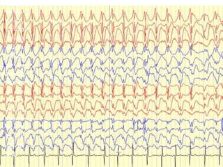 55
Fp1-F3
F3 –C3
C3 – P3
P3 – O1
Fp2 F4
F4 – C4
C4 – P4
P4 – O2
Fp1 –F7
F7 – T3
T3 – T5
T5 – O1
Fp2 F8
F8 – T4
T4 – T6
T6 – O2
EKG
 
