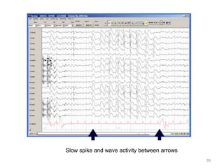 59
Slow spike and wave activity between arrows
 