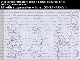 64
D 15 infant refractory tonic / partial seizures; BH N
MRI N / Metabolic N
EE with suppression – burst (OHTAHARA’s )
 