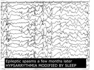 65
Epileptic spasms a few months later
HYPSARRYTHMIA MODIFIED BY SLEEP
 