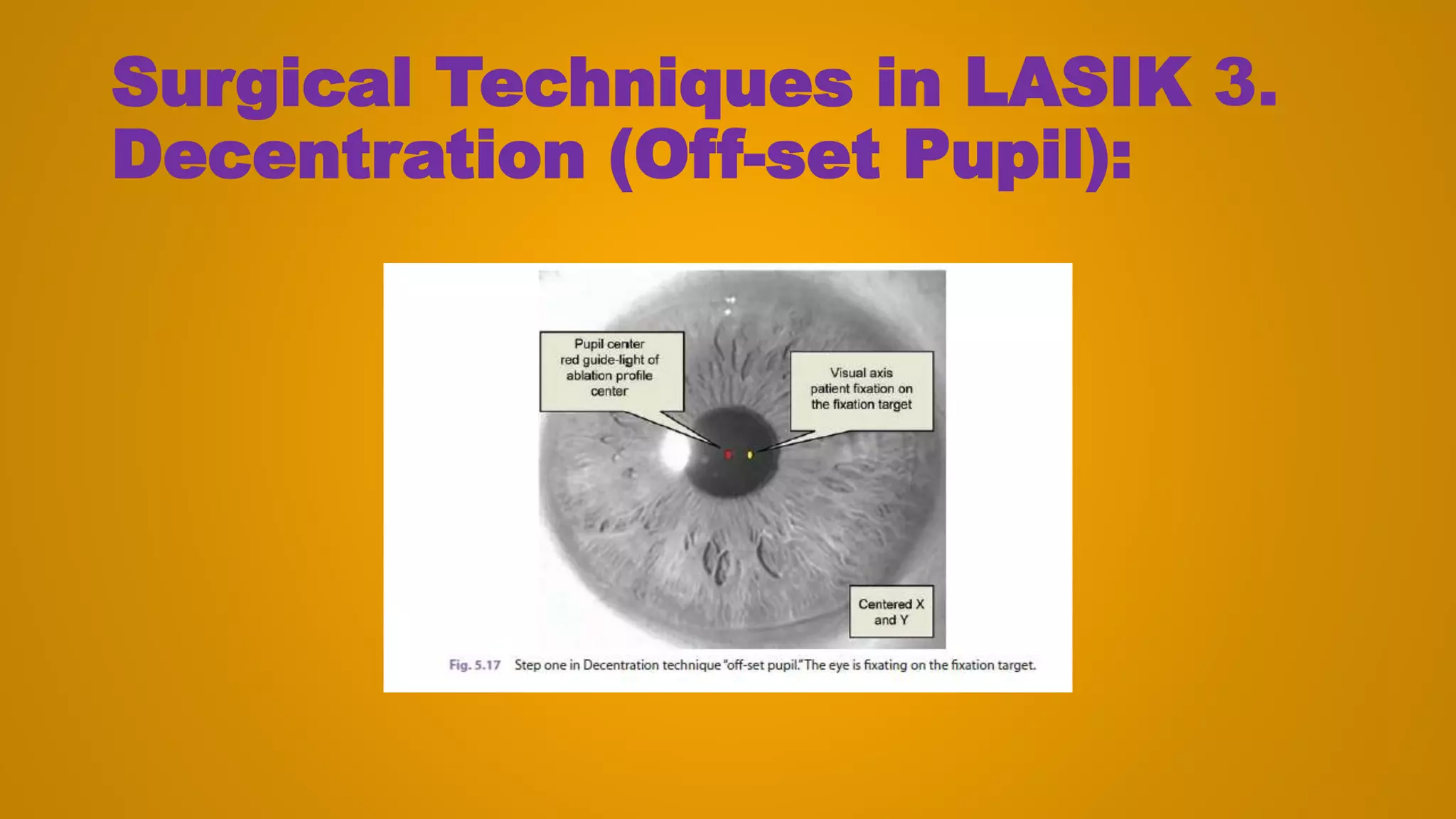 Surgical Techniques in LASIK 3.
Decentration (Off-set Pupil):
 