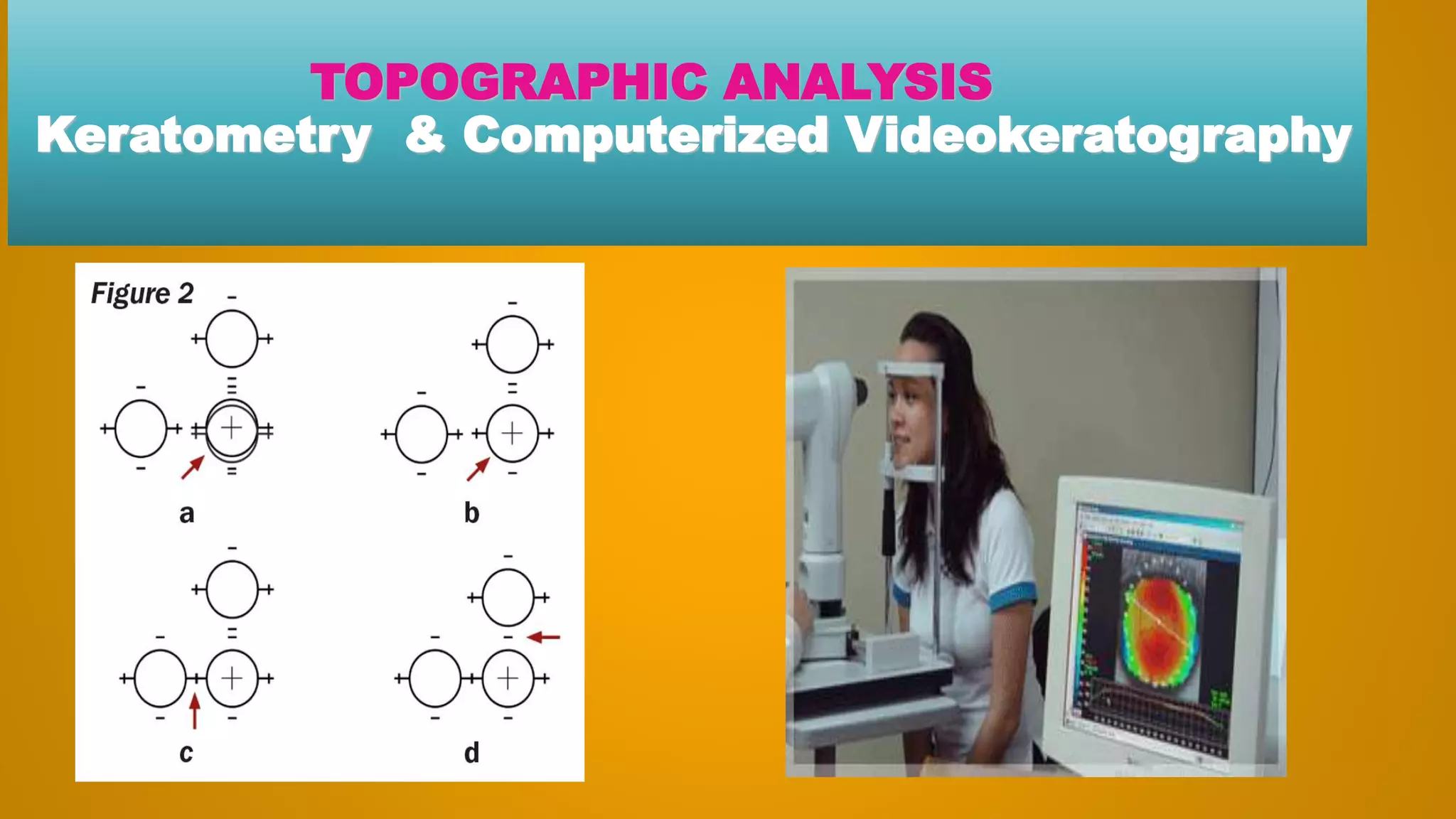 TOPOGRAPHIC ANALYSIS
Keratometry & Computerized Videokeratography
 