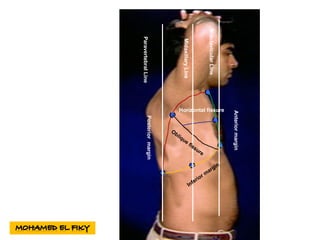 MidaxillaryLine
MidclavicularLine
ParavertebralLine
Posteriormargin
Anteriormargin
Horizontal fissure
 