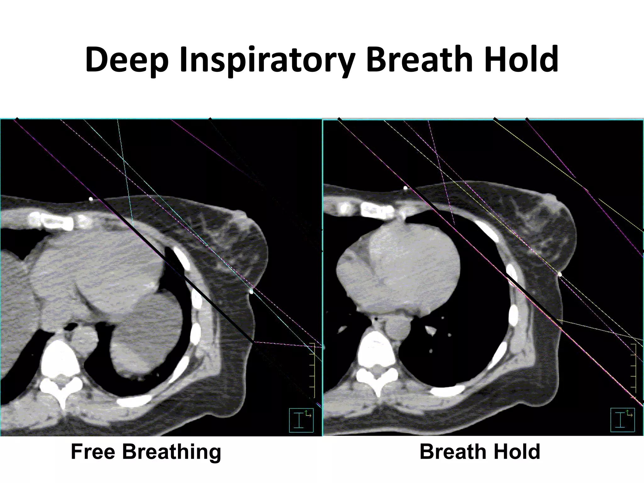 Free Breathing Breath Hold
Deep Inspiratory Breath Hold
 