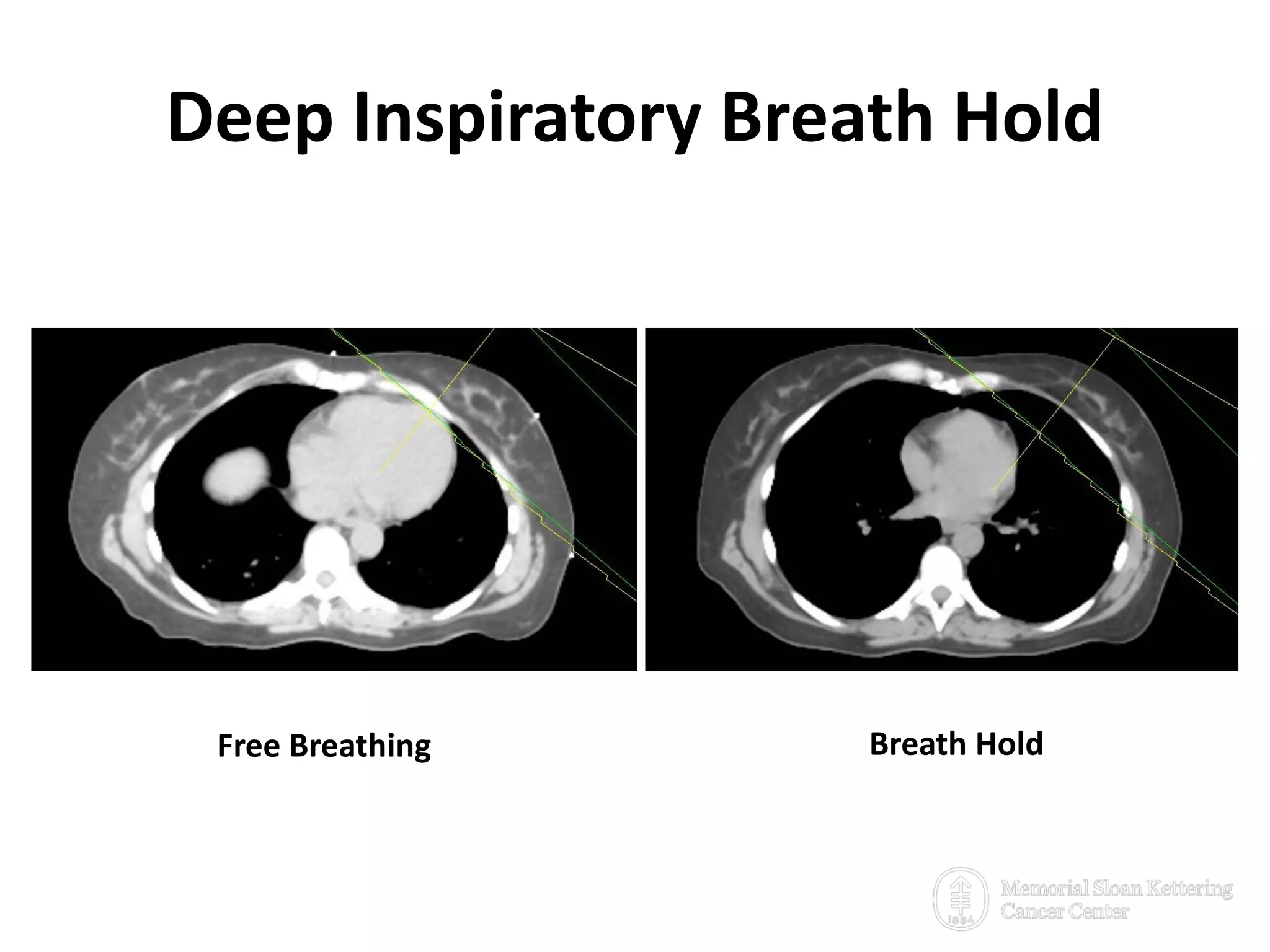  Verify if patient breath hold is reproducible, and if
patient can hold breath for 20 seconds.
Whether DIBH is beneficial for this patient?
Free Breathing Breath Hold
Deep Inspiratory Breath Hold
 