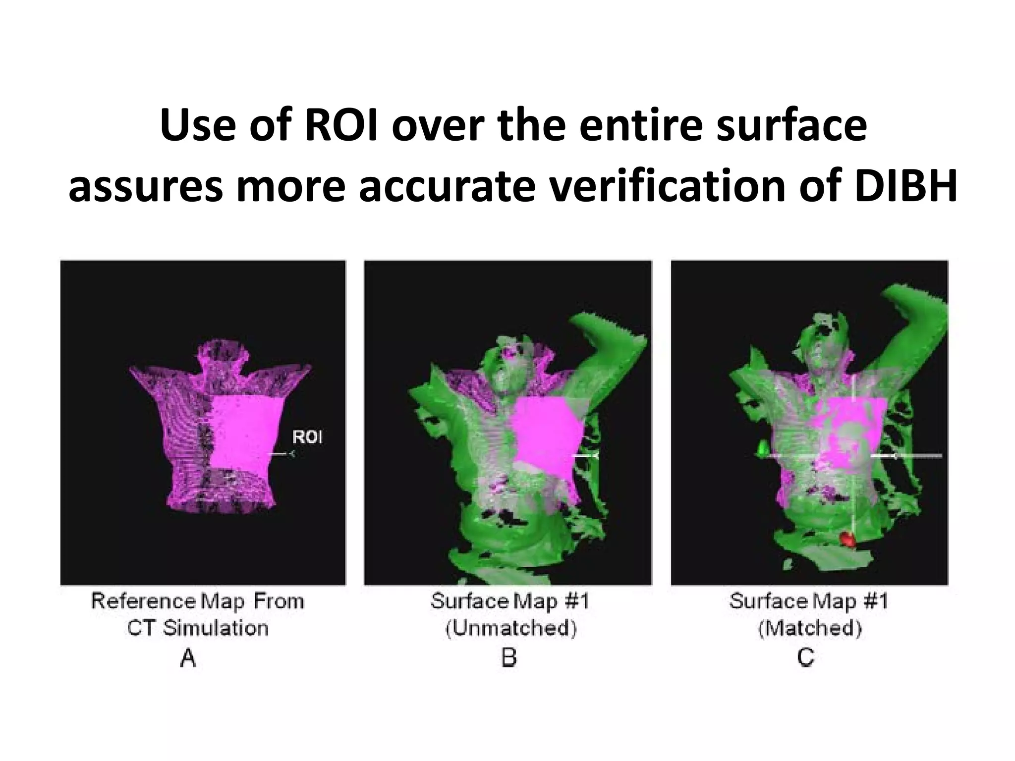 Use of ROI over the entire surface
assures more accurate verification of DIBH
 