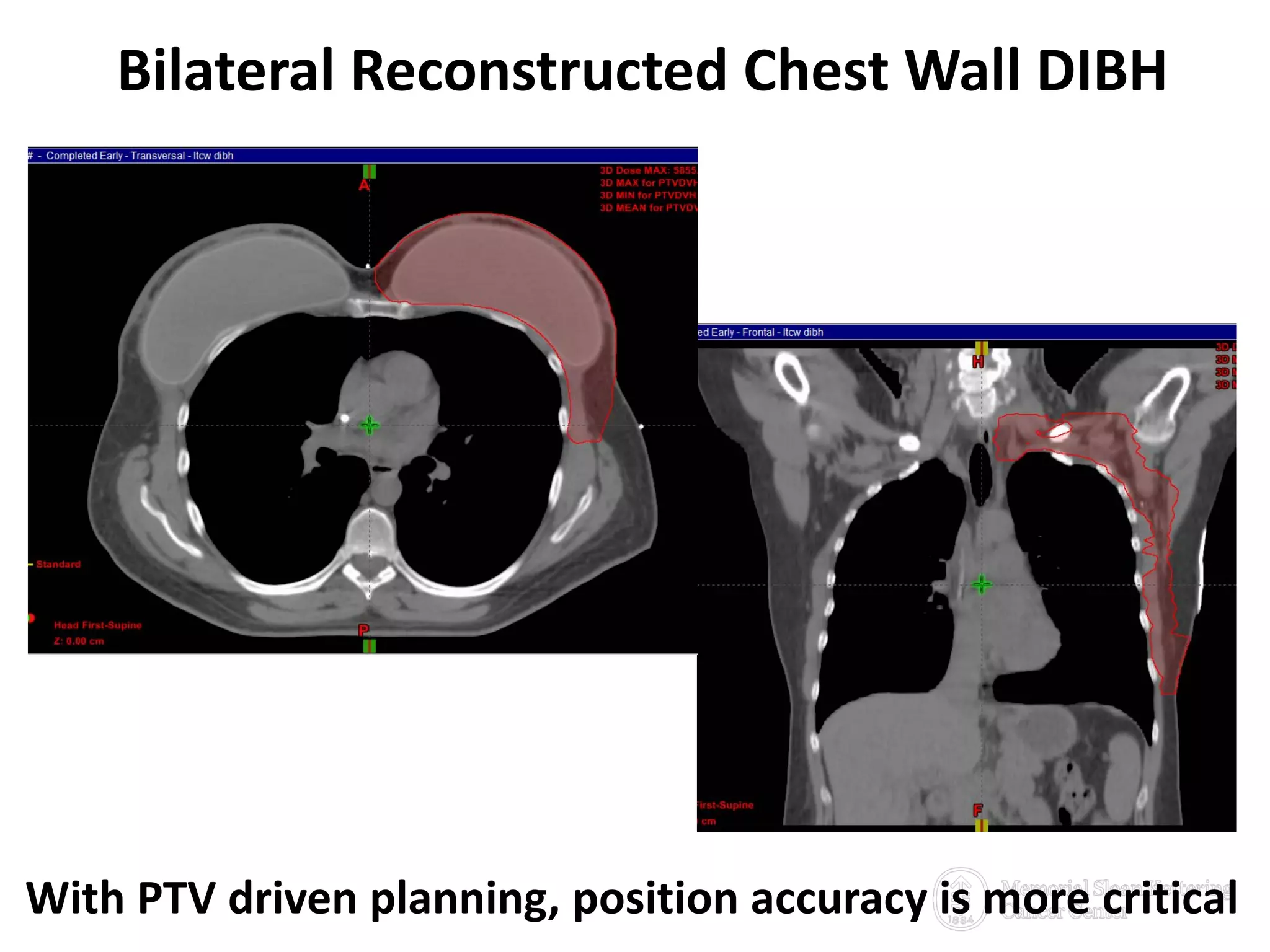 Bilateral Reconstructed Chest Wall DIBH
20With PTV driven planning, position accuracy is more critical
 