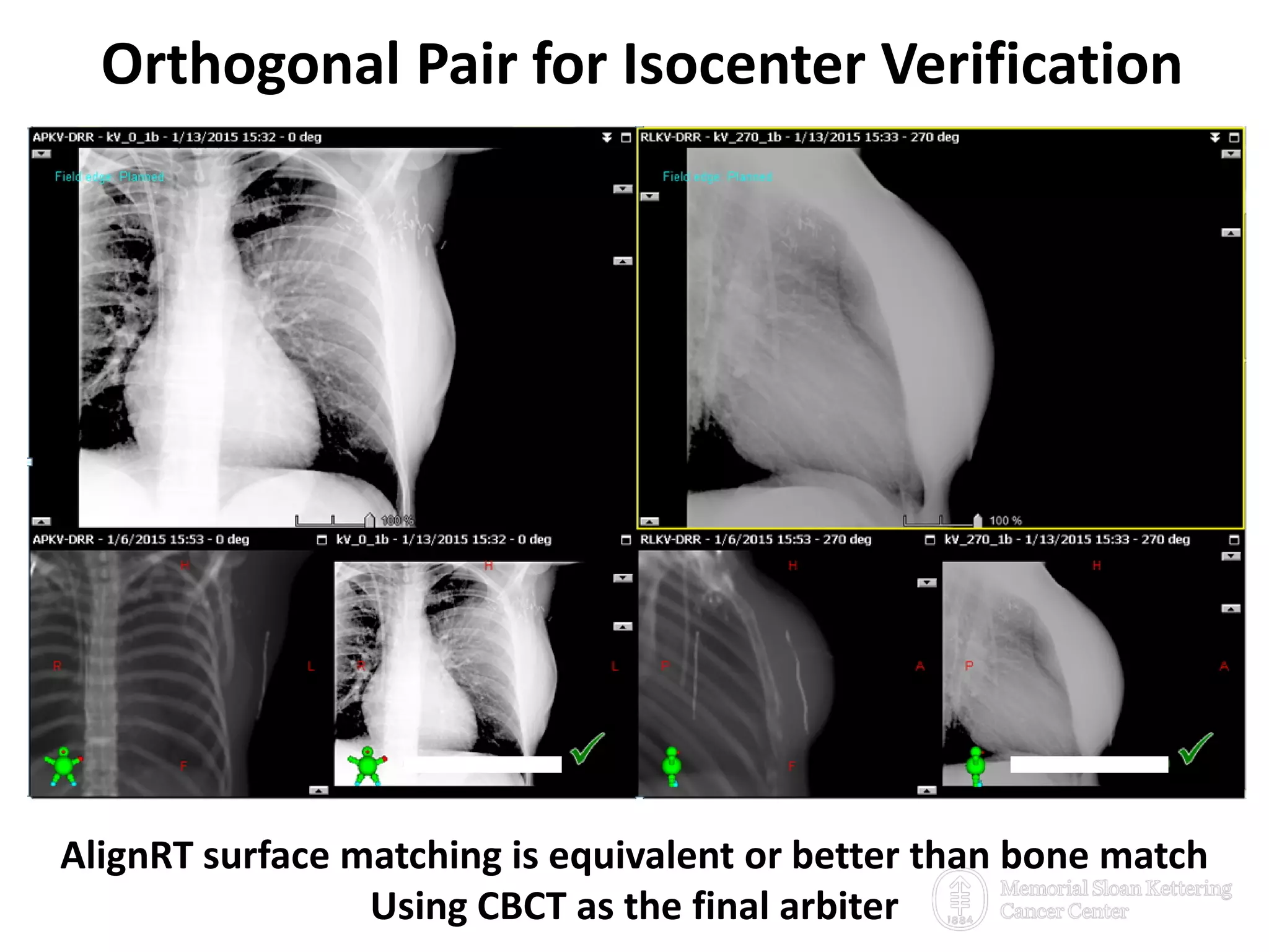 Orthogonal Pair for Isocenter Verification
23
AlignRT surface matching is equivalent or better than bone match
Using CBCT as the final arbiter
 