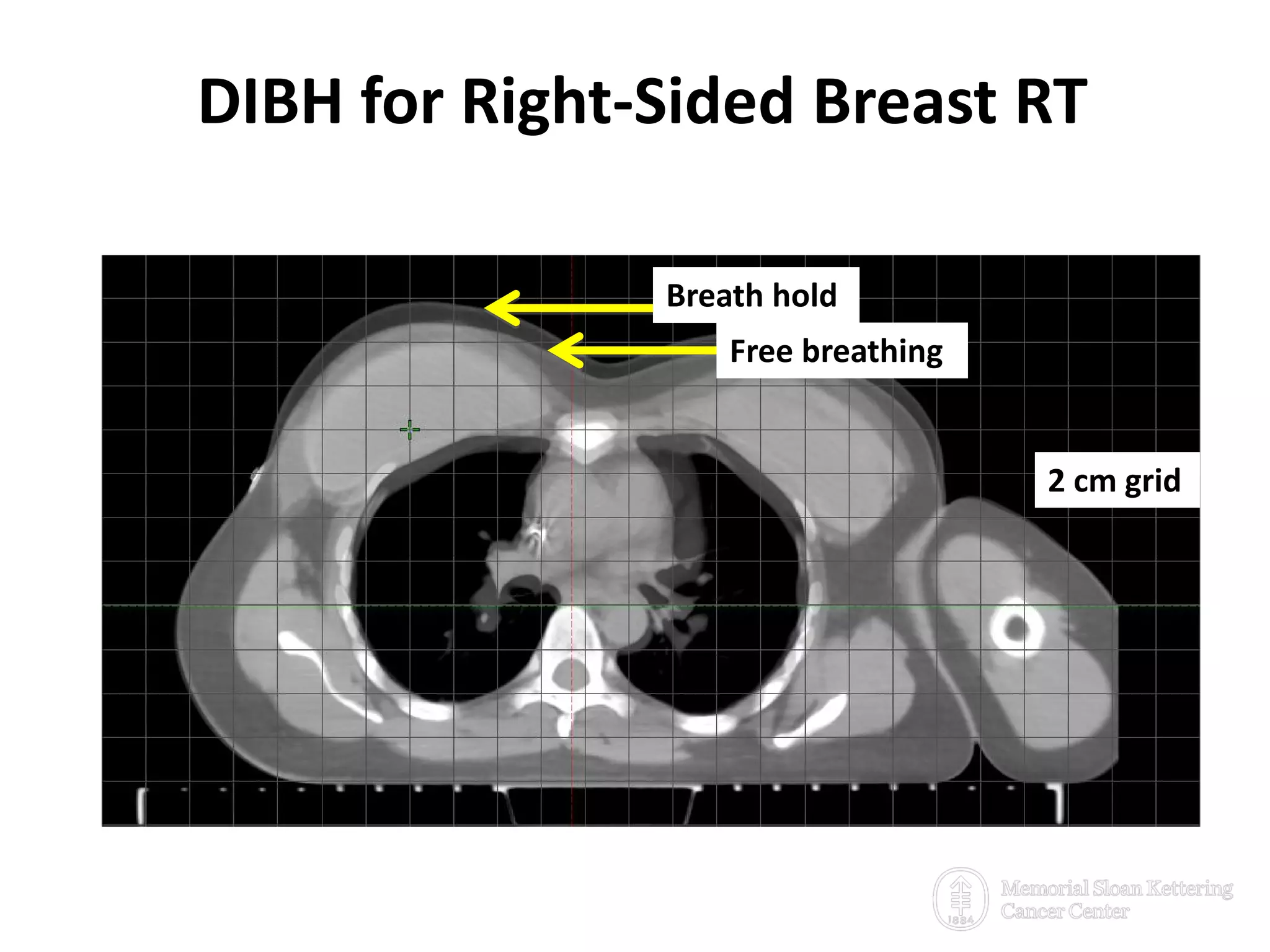 DIBH for Right-Sided Breast RT
25
 To spare contra-lateral breast
2 cm grid
Free breathing
Breath hold
 