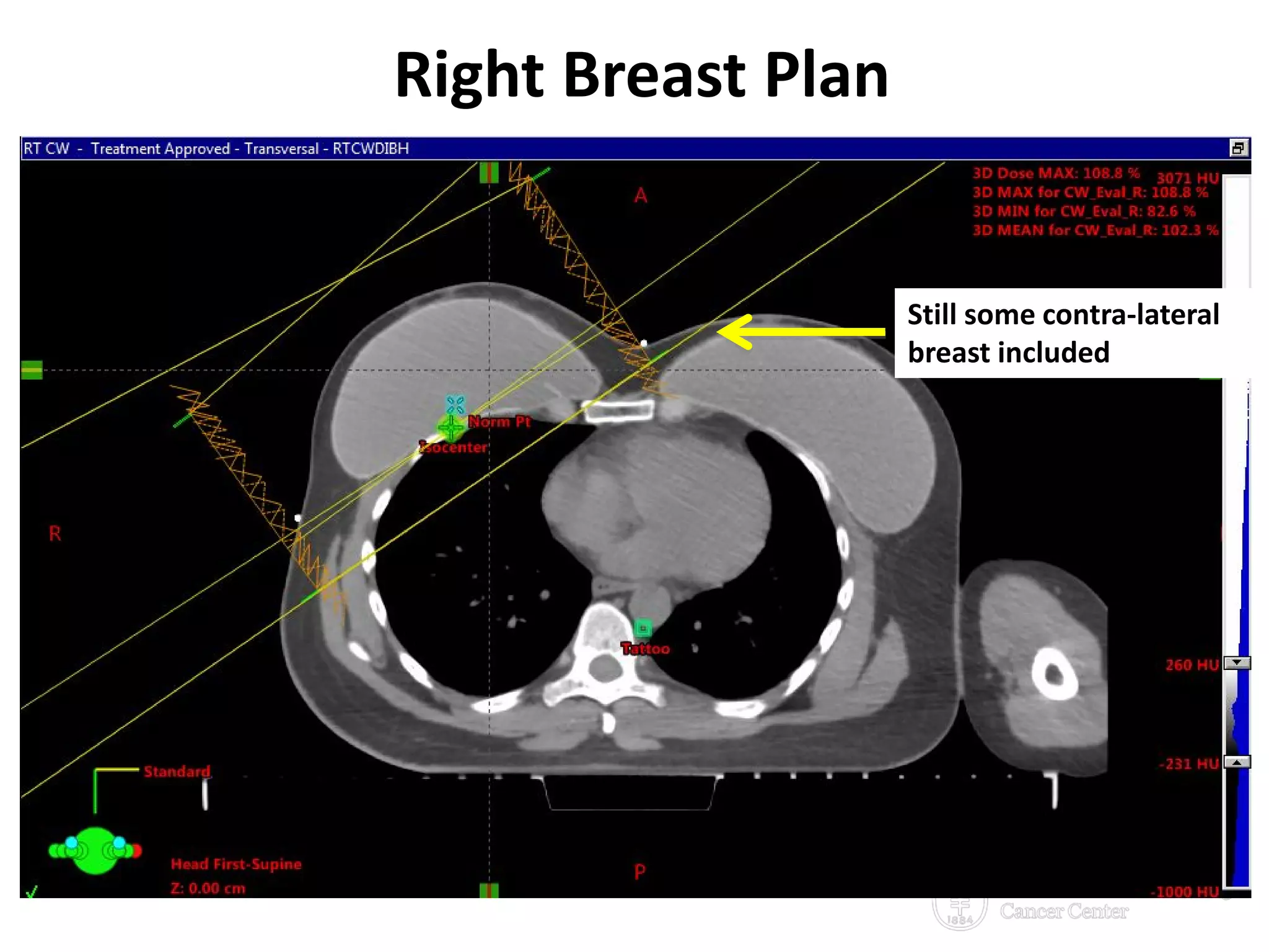 Right Breast Plan
6/29/2016 26
Still some contra-lateral
breast included
 
