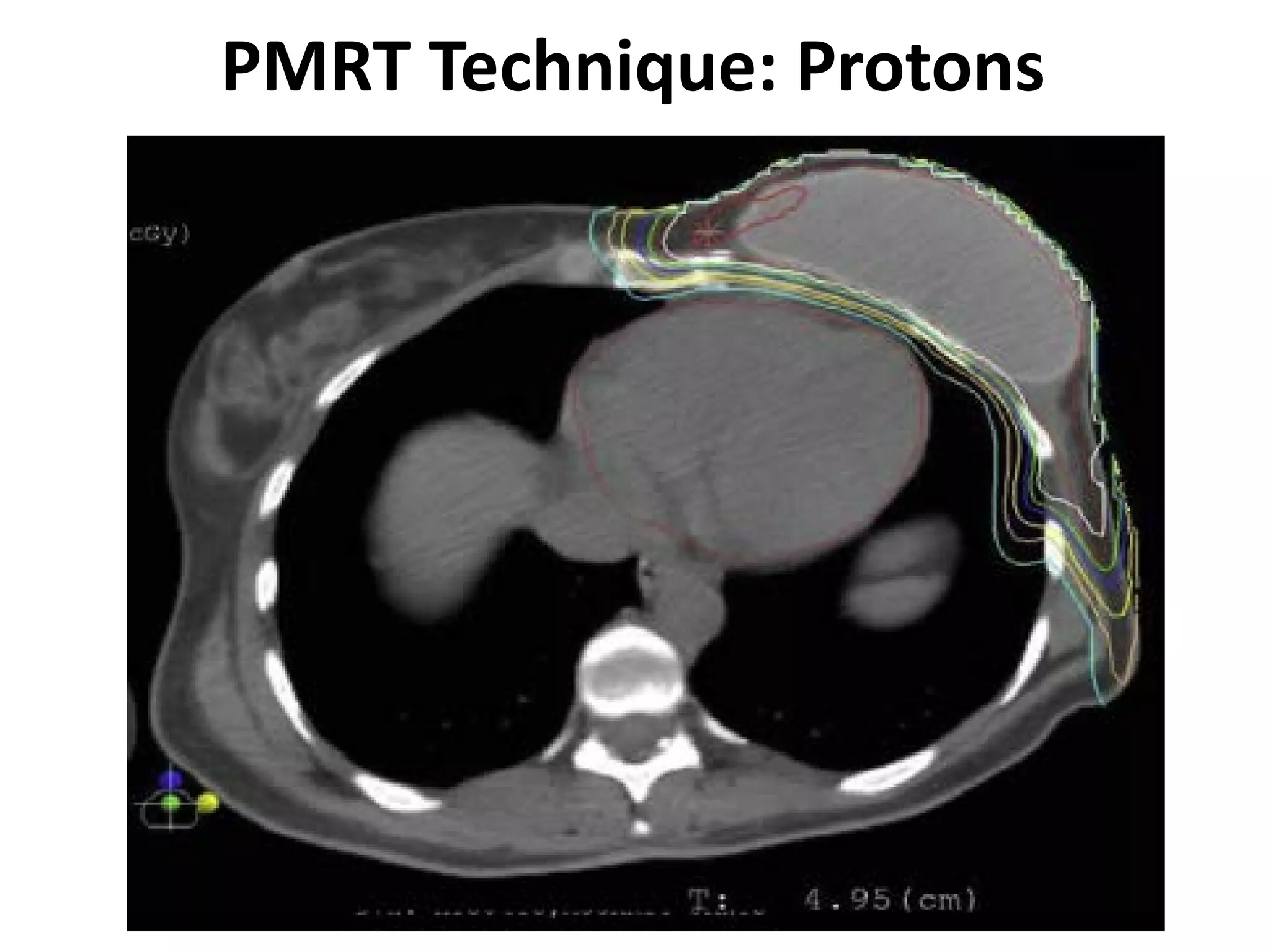 PMRT Technique: Protons
 