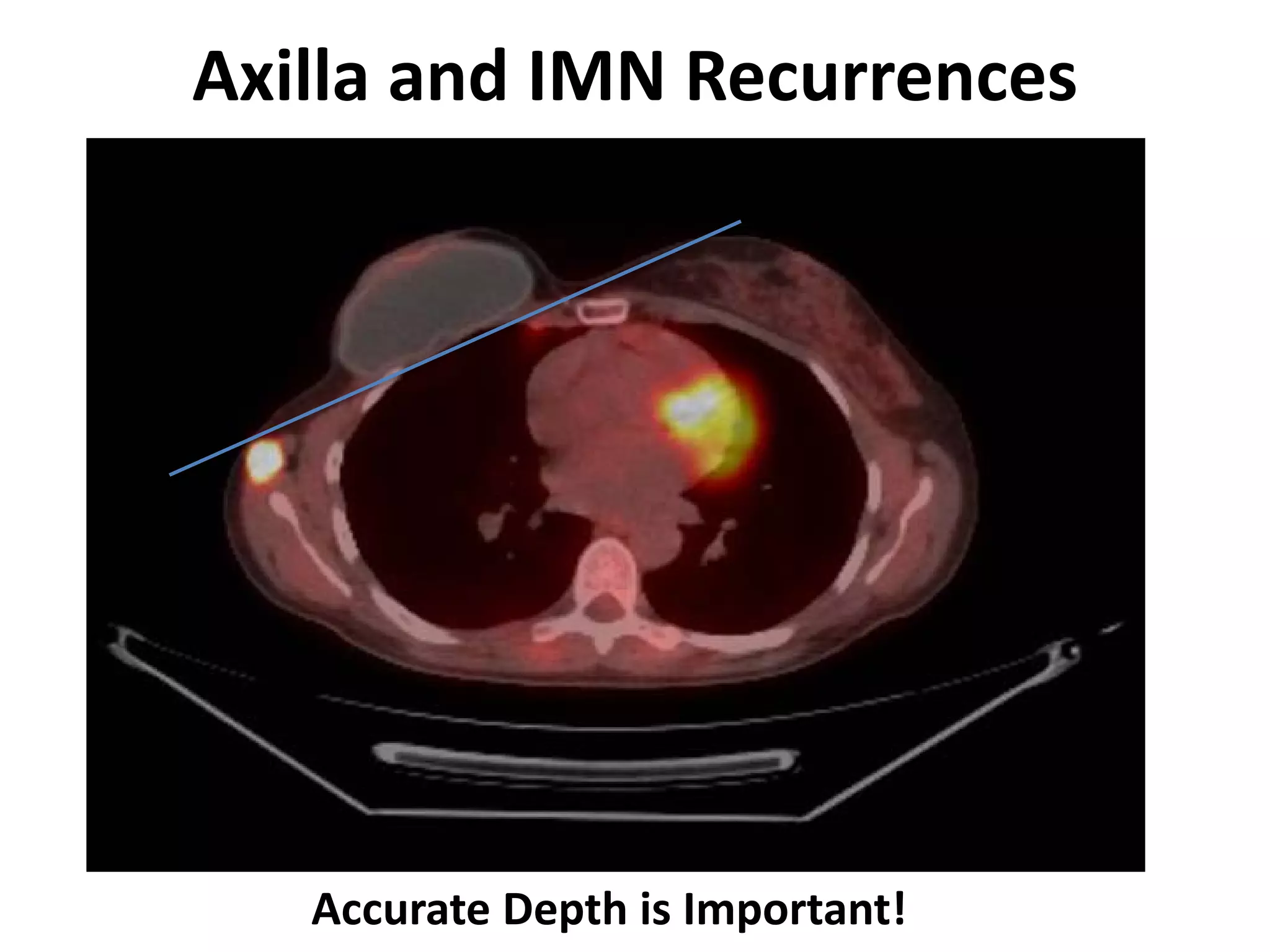 Axilla and IMN Recurrences
Accurate Depth is Important!
 