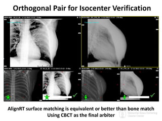Surface Guided Radiotherapy for Accuracy, Volume Reduction, Real time ...