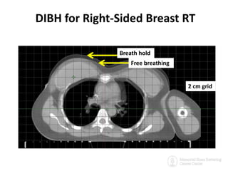 Surface Guided Radiotherapy for Accuracy, Volume Reduction, Real time ...