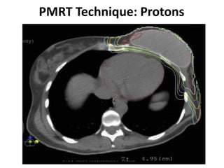 Surface Guided Radiotherapy for Accuracy, Volume Reduction, Real time ...