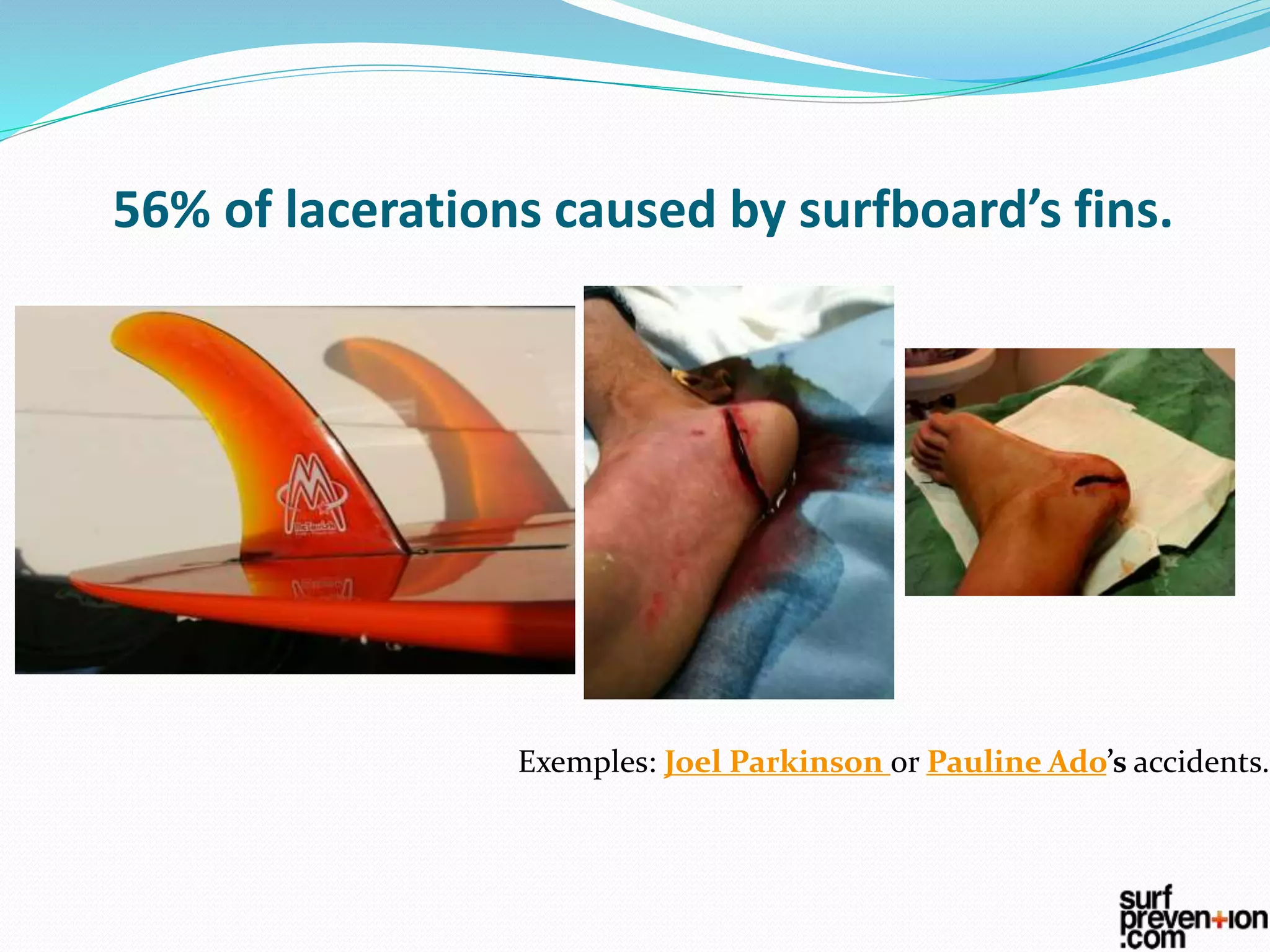 56% of lacerations caused by surfboard’s fins.
Exemples: Joel Parkinson or Pauline Ado’s accidents.
 