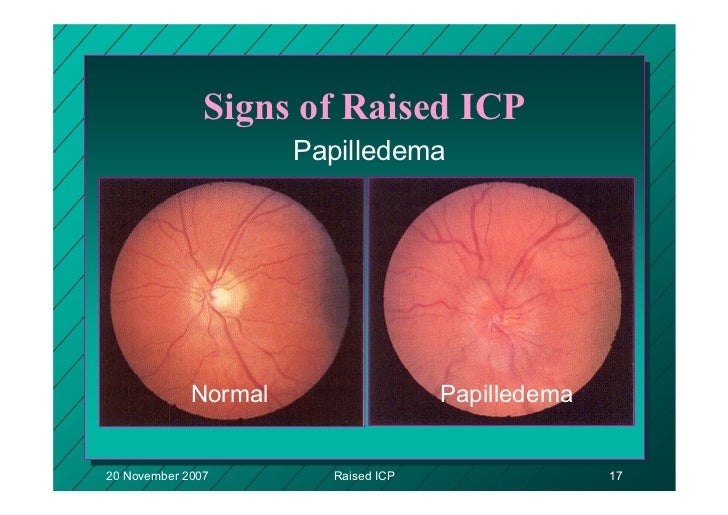 Surg351 presentation and management of raised intracranial pressure