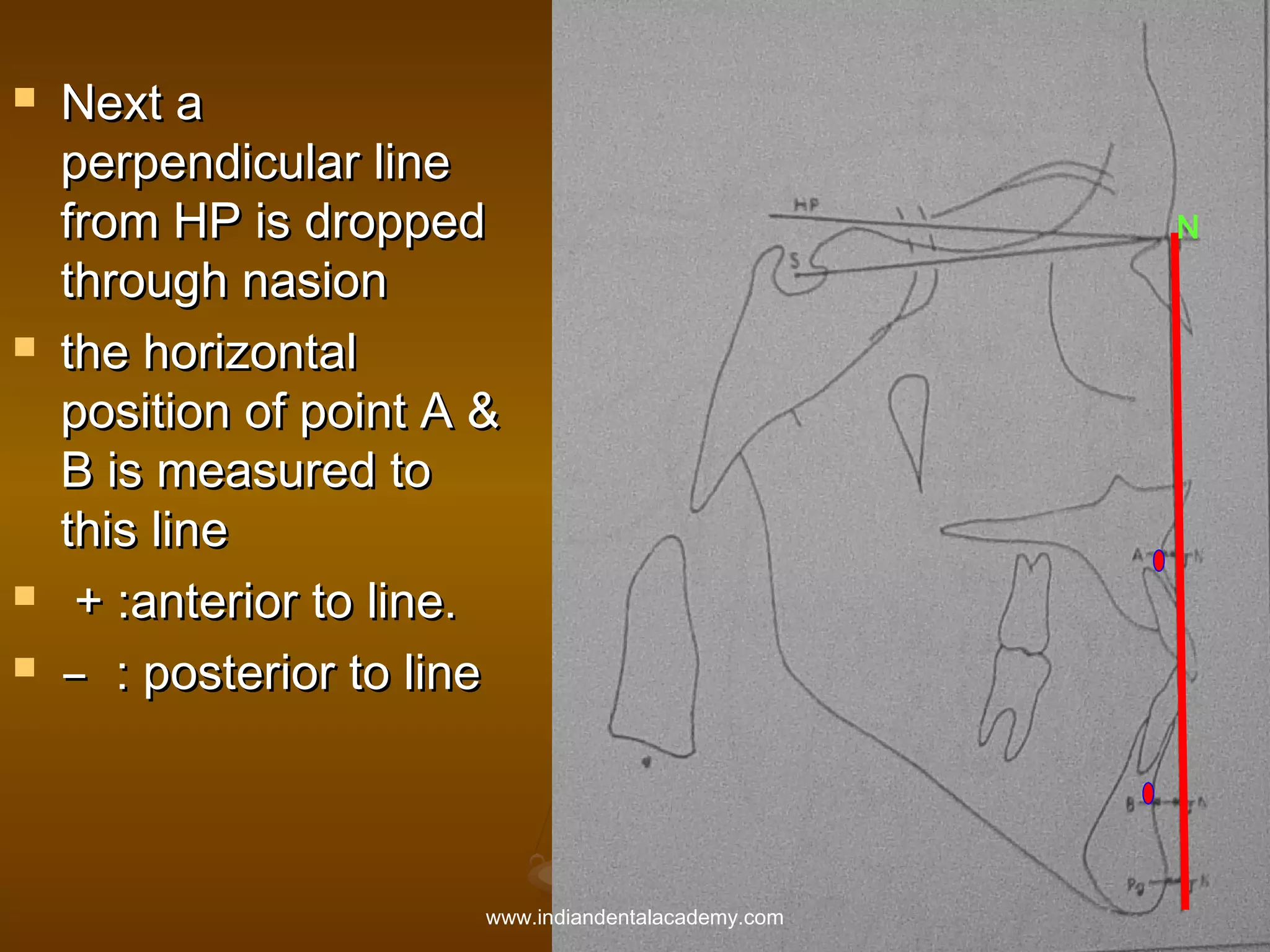 






Next a
perpendicular line
from HP is dropped
through nasion
the horizontal
position of point A &
B is measured to
this line
+ :anterior to line.
̶ : posterior to line

www.indiandentalacademy.com

N

 