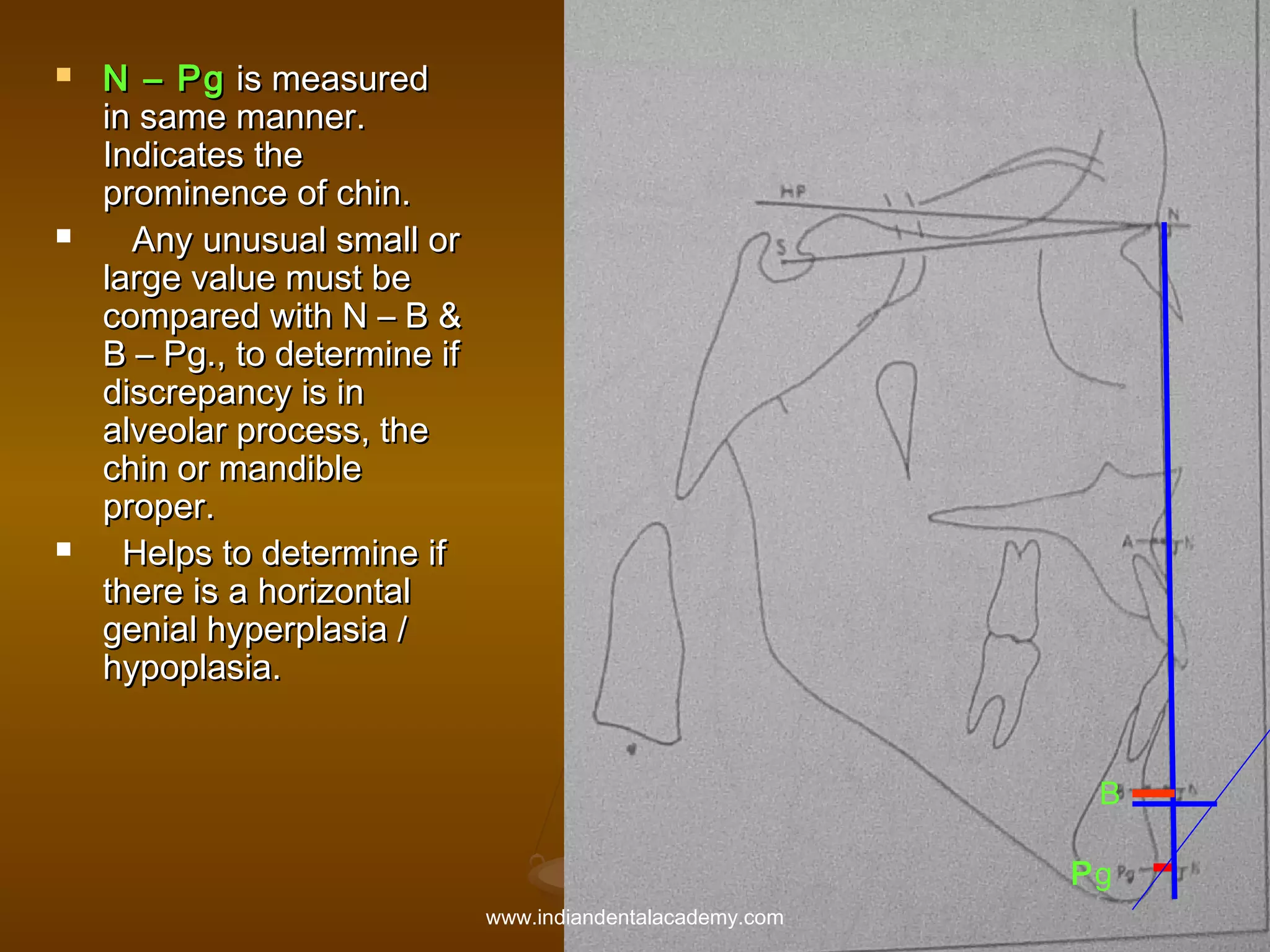 





N – Pg is measured
in same manner.
Indicates the
prominence of chin.
Any unusual small or
large value must be
compared with N – B &
B – Pg., to determine if
discrepancy is in
alveolar process, the
chin or mandible
proper.
Helps to determine if
there is a horizontal
genial hyperplasia /
hypoplasia.
B
Pg
www.indiandentalacademy.com

 