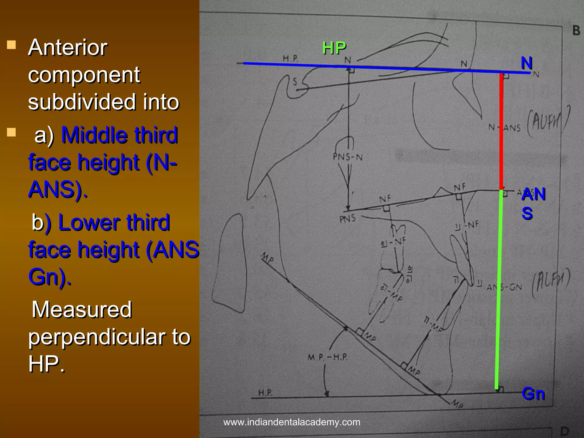 



Anterior
component
subdivided into
a) Middle third
face height (NANS).
b) Lower third
face height (ANSGn).
Measured
perpendicular to
HP.

HP

N

AN
S

Gn
www.indiandentalacademy.com

 