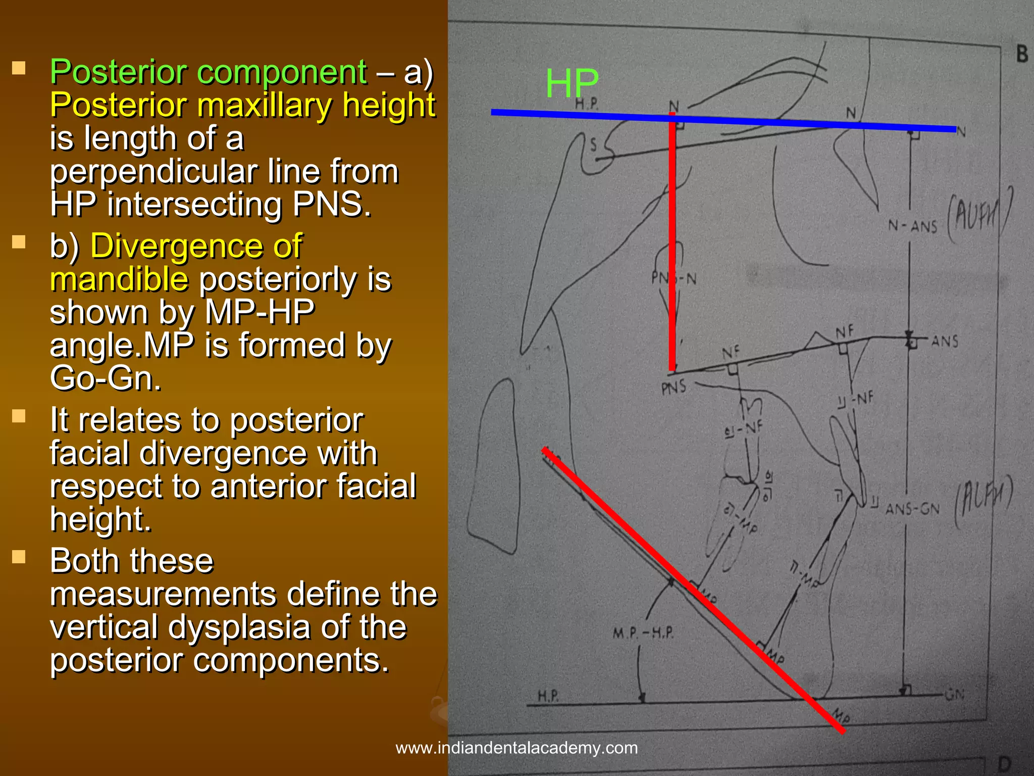 







Posterior component – a)
Posterior maxillary height
is length of a
perpendicular line from
HP intersecting PNS.
b) Divergence of
mandible posteriorly is
shown by MP-HP
angle.MP is formed by
Go-Gn.
It relates to posterior
facial divergence with
respect to anterior facial
height.
Both these
measurements define the
vertical dysplasia of the
posterior components.

HP

www.indiandentalacademy.com

 