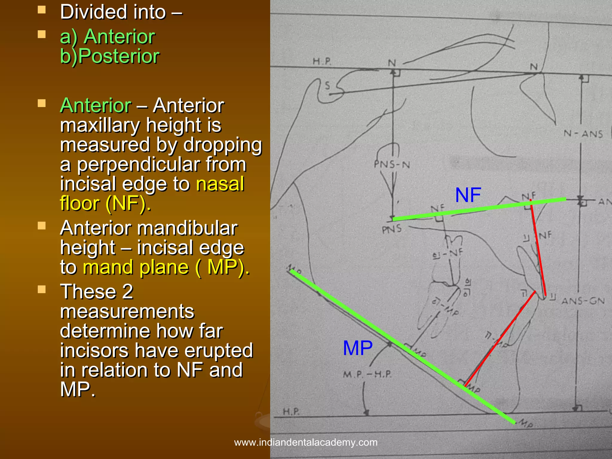 








Divided into –
a) Anterior
b)Posterior
Anterior – Anterior
maxillary height is
measured by dropping
a perpendicular from
incisal edge to nasal
floor (NF).
Anterior mandibular
height – incisal edge
to mand plane ( MP).
These 2
measurements
determine how far
incisors have erupted
in relation to NF and
MP.

NF

MP

www.indiandentalacademy.com

 