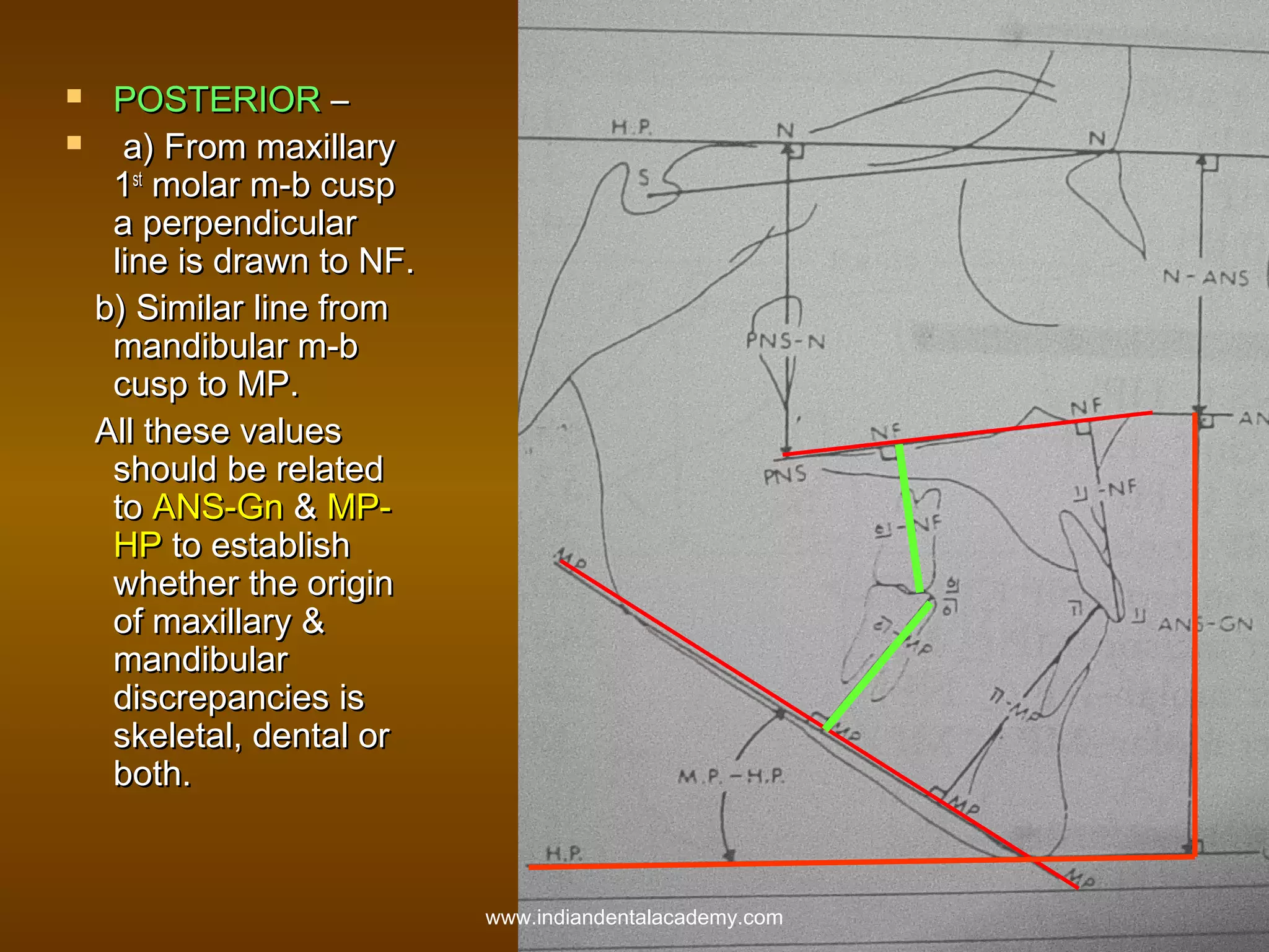 


POSTERIOR –
a) From maxillary
1st molar m-b cusp
a perpendicular
line is drawn to NF.
b) Similar line from
mandibular m-b
cusp to MP.
All these values
should be related
to ANS-Gn & MPHP to establish
whether the origin
of maxillary &
mandibular
discrepancies is
skeletal, dental or
both.

www.indiandentalacademy.com

 