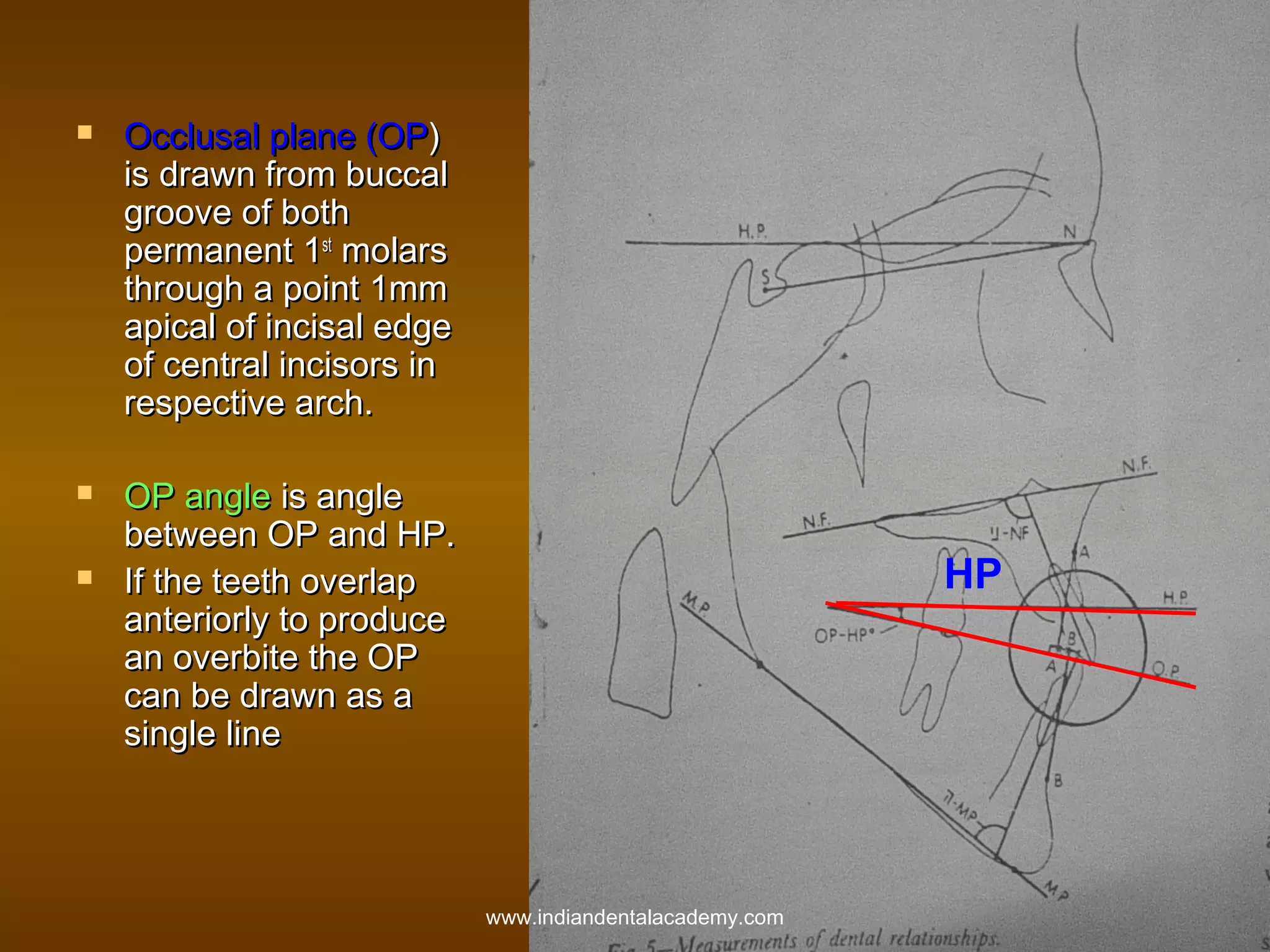 





Occlusal plane (OP)
is drawn from buccal
groove of both
permanent 1st molars
through a point 1mm
apical of incisal edge
of central incisors in
respective arch.
OP angle is angle
between OP and HP.
If the teeth overlap
anteriorly to produce
an overbite the OP
can be drawn as a
single line

HP

www.indiandentalacademy.com

 
