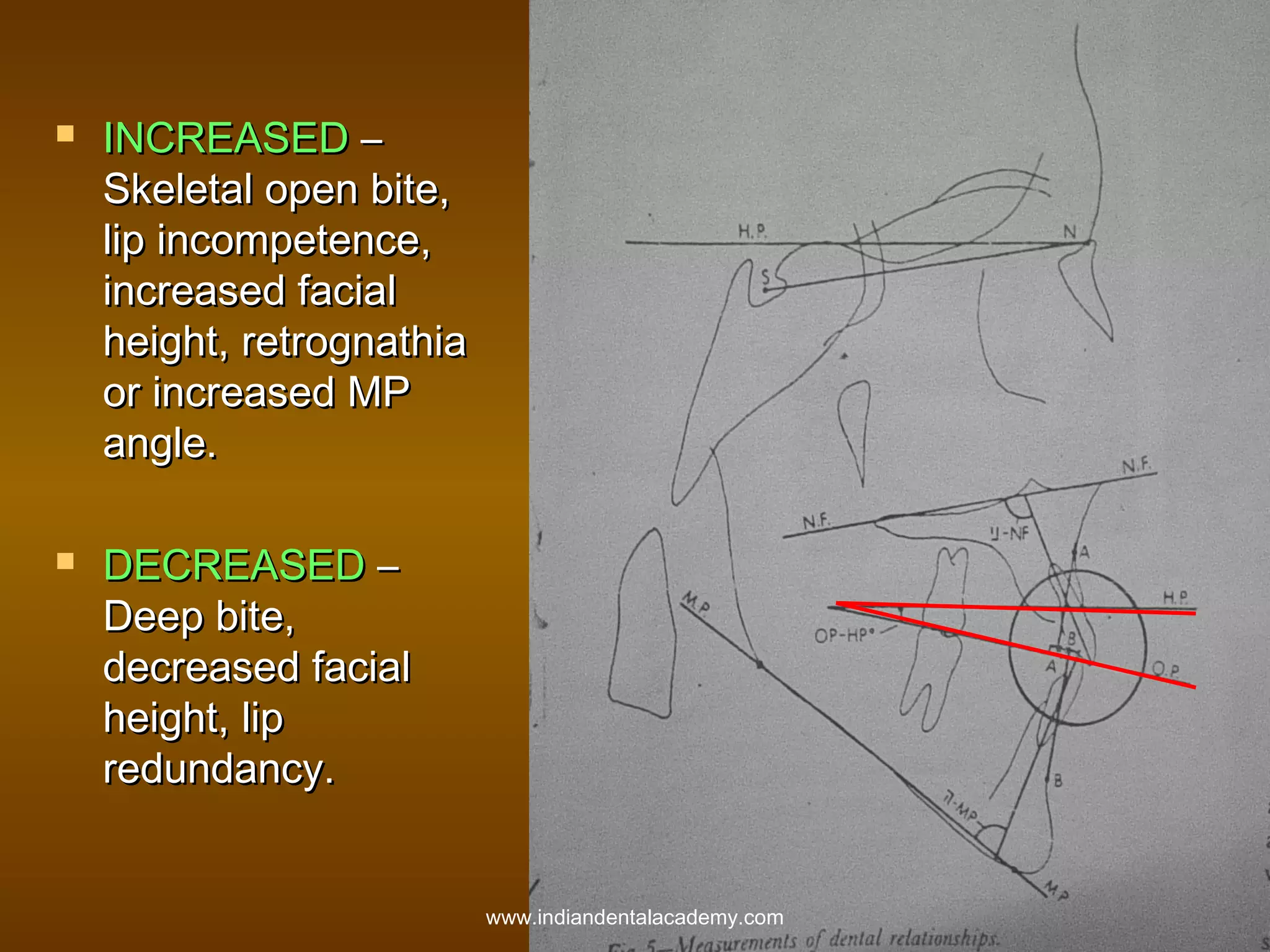 



INCREASED –
Skeletal open bite,
lip incompetence,
increased facial
height, retrognathia
or increased MP
angle.
DECREASED –
Deep bite,
decreased facial
height, lip
redundancy.
www.indiandentalacademy.com

 