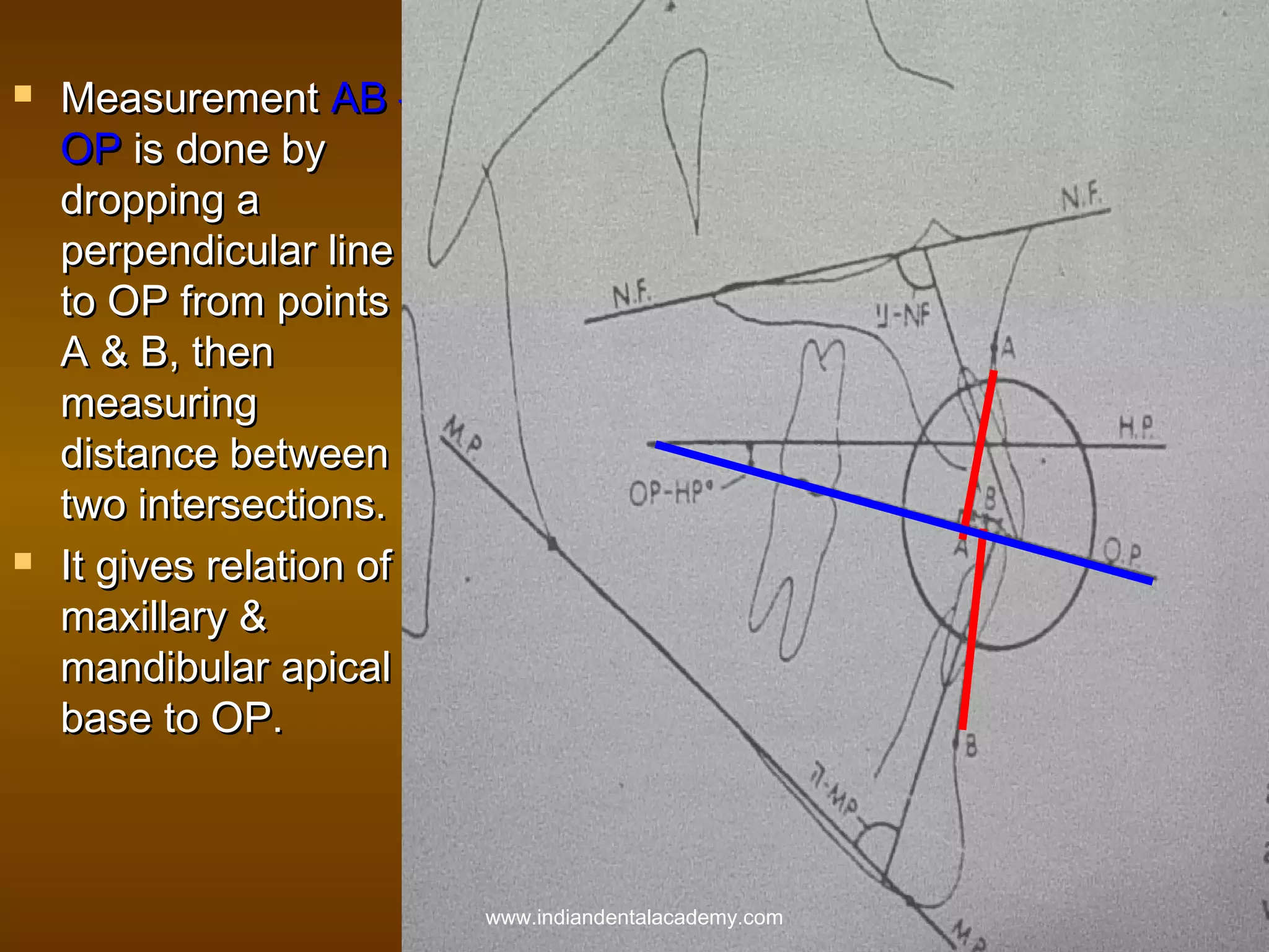 



Measurement AB –
OP is done by
dropping a
perpendicular line
to OP from points
A & B, then
measuring
distance between
two intersections.
It gives relation of
maxillary &
mandibular apical
base to OP.

www.indiandentalacademy.com

 