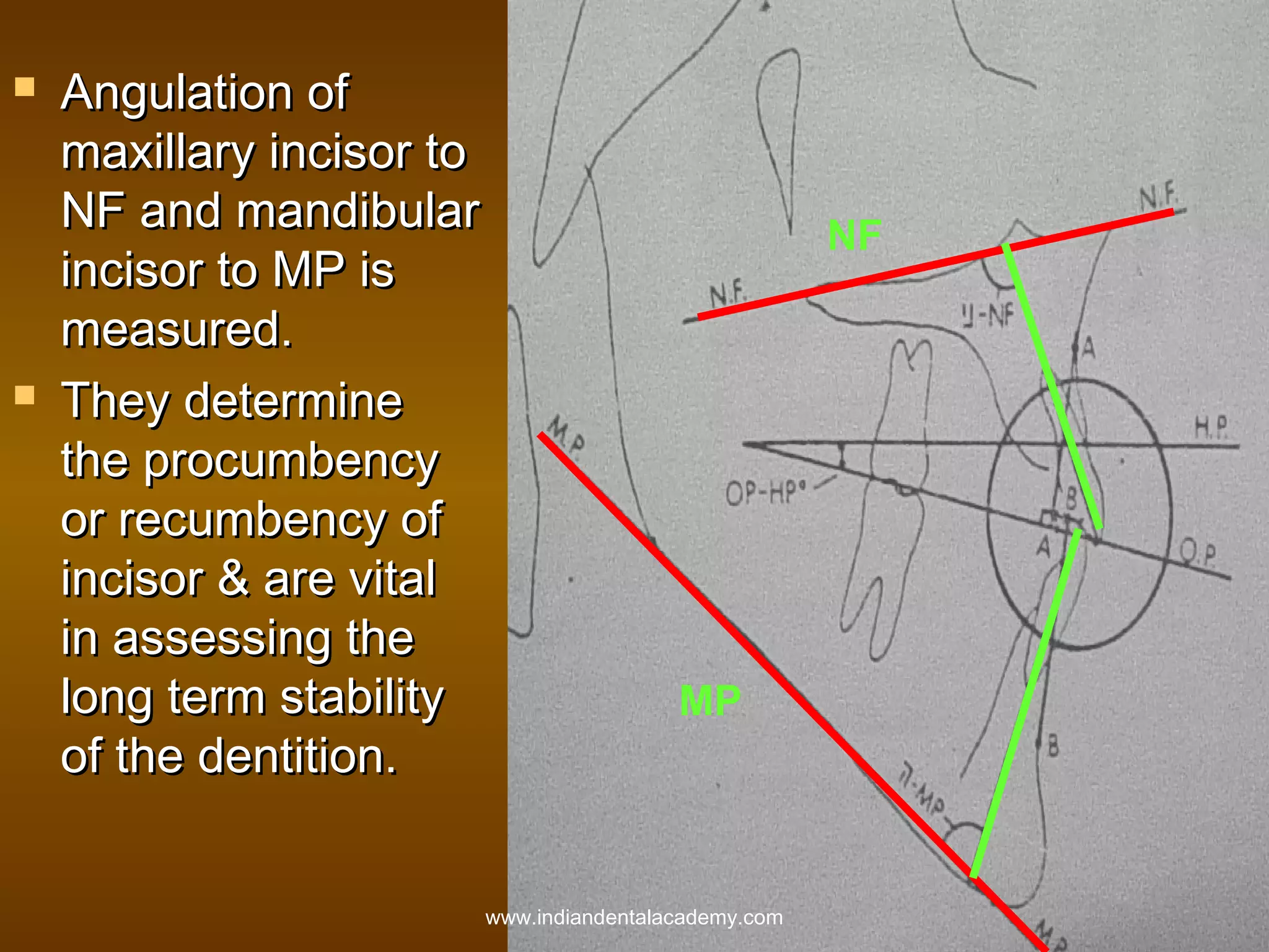 



Angulation of
maxillary incisor to
NF and mandibular
incisor to MP is
measured.
They determine
the procumbency
or recumbency of
incisor & are vital
in assessing the
long term stability
of the dentition.

NF

MP

www.indiandentalacademy.com

 