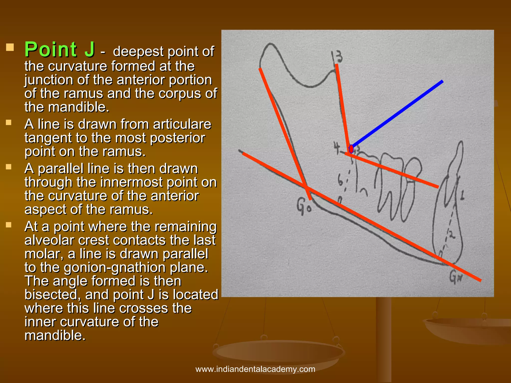 







Point J -

deepest point of
the curvature formed at the
junction of the anterior portion
of the ramus and the corpus of
the mandible.
A line is drawn from articulare
tangent to the most posterior
point on the ramus.
A parallel line is then drawn
through the innermost point on
the curvature of the anterior
aspect of the ramus.
At a point where the remaining
alveolar crest contacts the last
molar, a line is drawn parallel
to the gonion-gnathion plane.
The angle formed is then
bisected, and point J is located
where this line crosses the
inner curvature of the
mandible.
www.indiandentalacademy.com

 