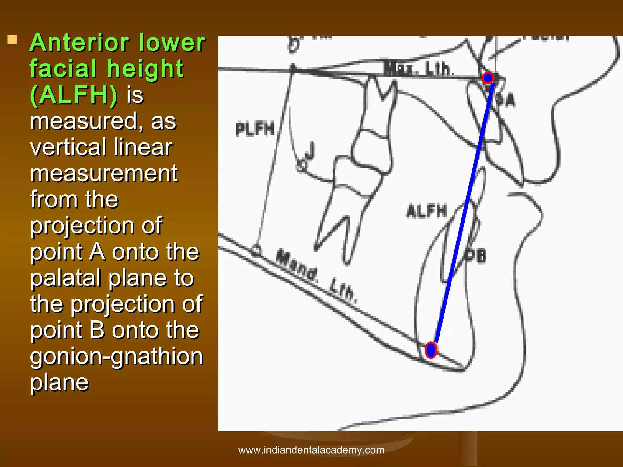 

Anterior lower
facial height
(ALFH) is
measured, as
vertical linear
measurement
from the
projection of
point A onto the
palatal plane to
the projection of
point B onto the
gonion-gnathion
plane
www.indiandentalacademy.com

 