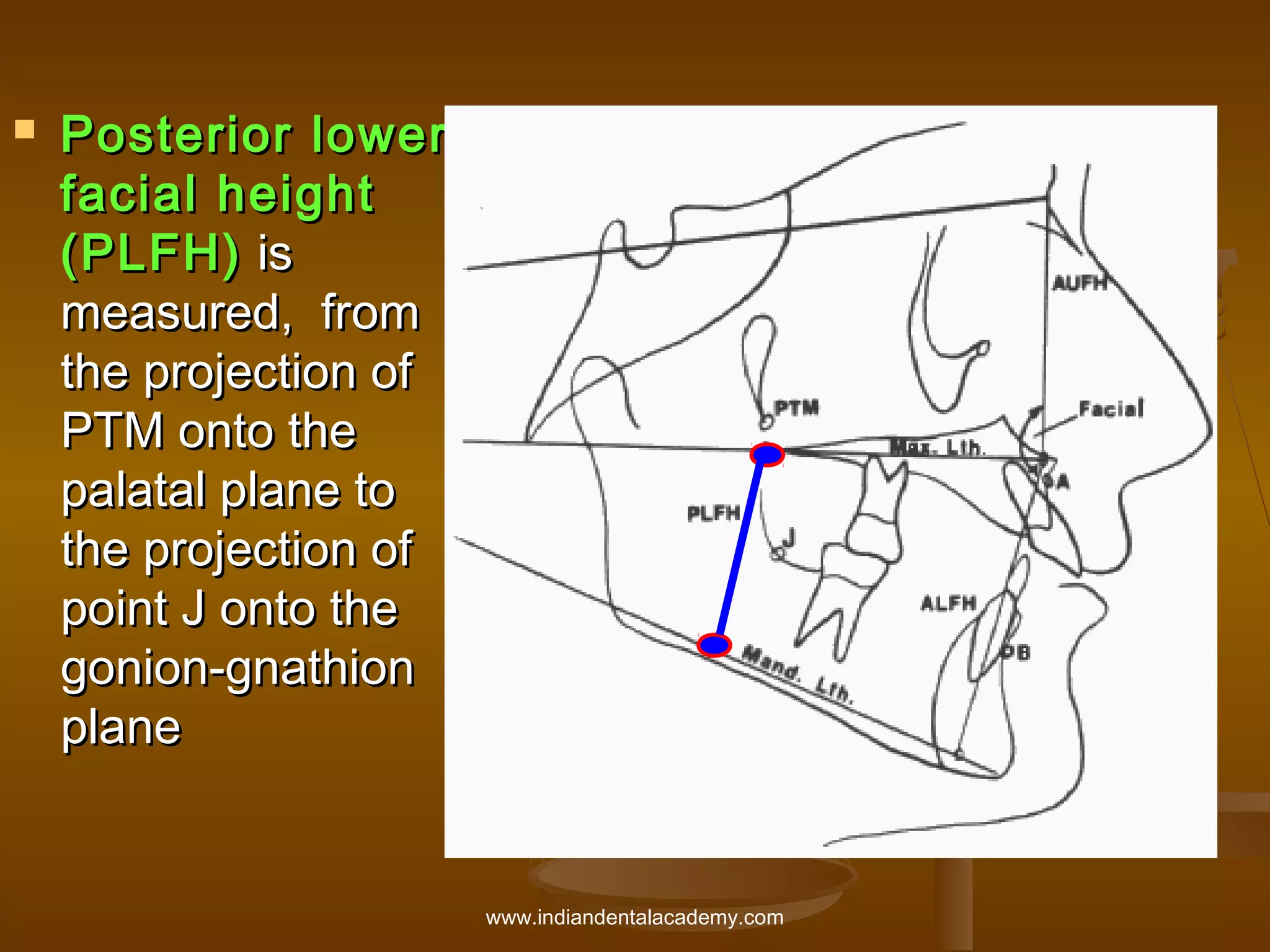 

Posterior lower
facial height
(PLFH) is
measured, from
the projection of
PTM onto the
palatal plane to
the projection of
point J onto the
gonion-gnathion
plane

www.indiandentalacademy.com

 