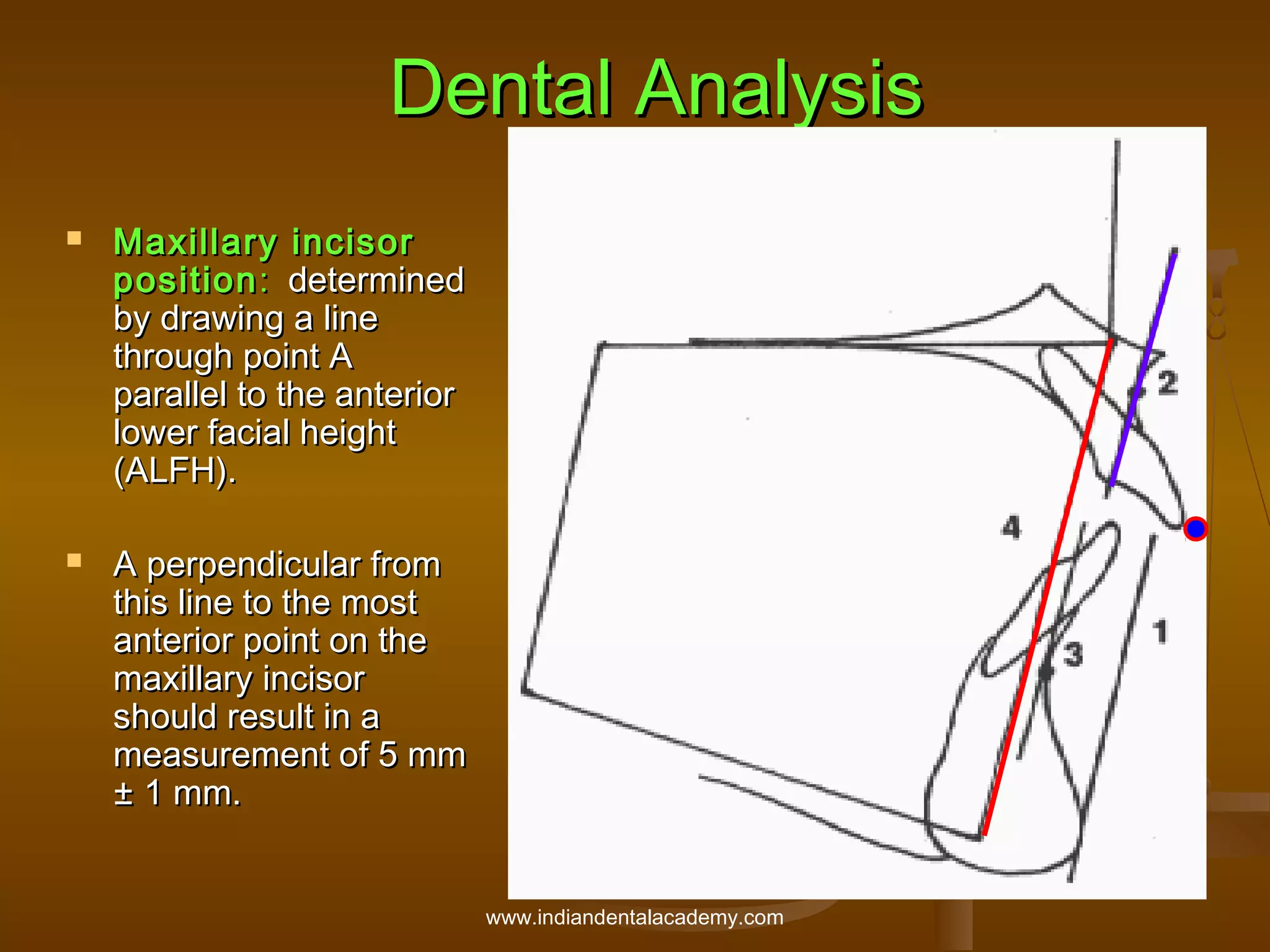 Dental Analysis




Maxillary incisor
position : determined
by drawing a line
through point A
parallel to the anterior
lower facial height
(ALFH).
A perpendicular from
this line to the most
anterior point on the
maxillary incisor
should result in a
measurement of 5 mm
± 1 mm.
www.indiandentalacademy.com

 